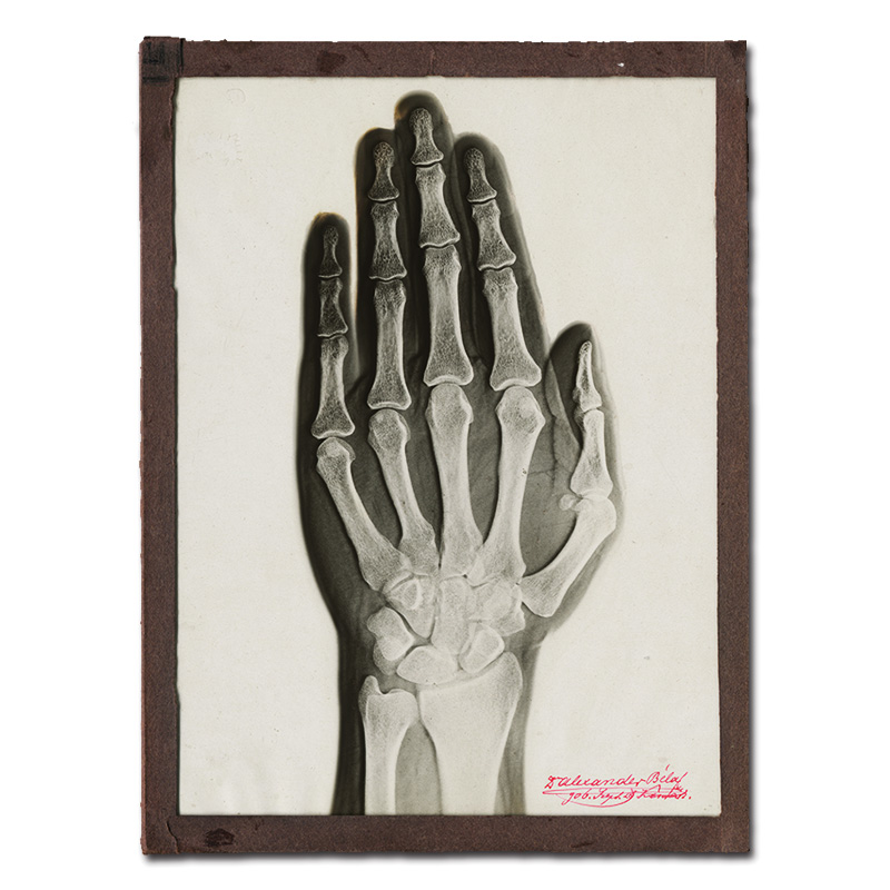Plastická röntgenová snímka ruky, ktorú vyhotovil Dr. Vojtech Alexander.